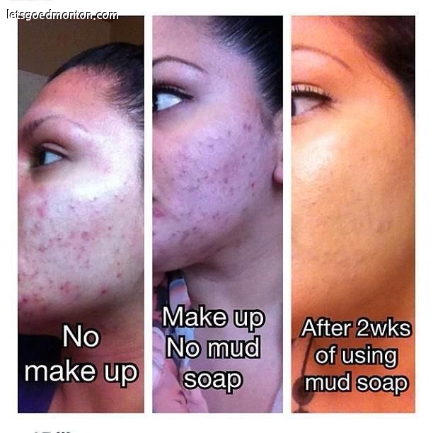 1d0a80f1e5c5a4550c34f8bf26e0902a--soap-shop-acne-skin.jpg